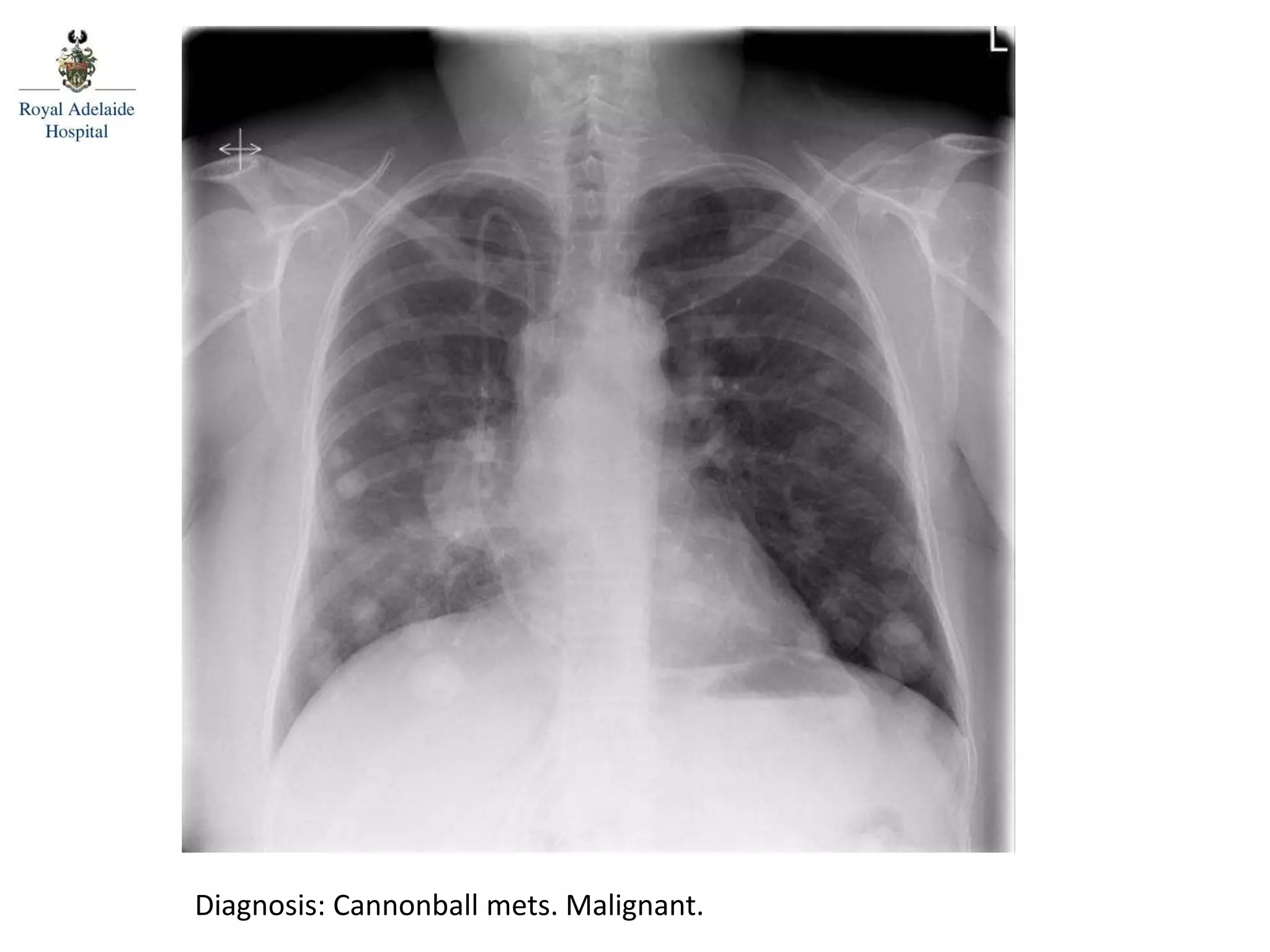 Diagnosis: Cannonball mets. Malignant.
 