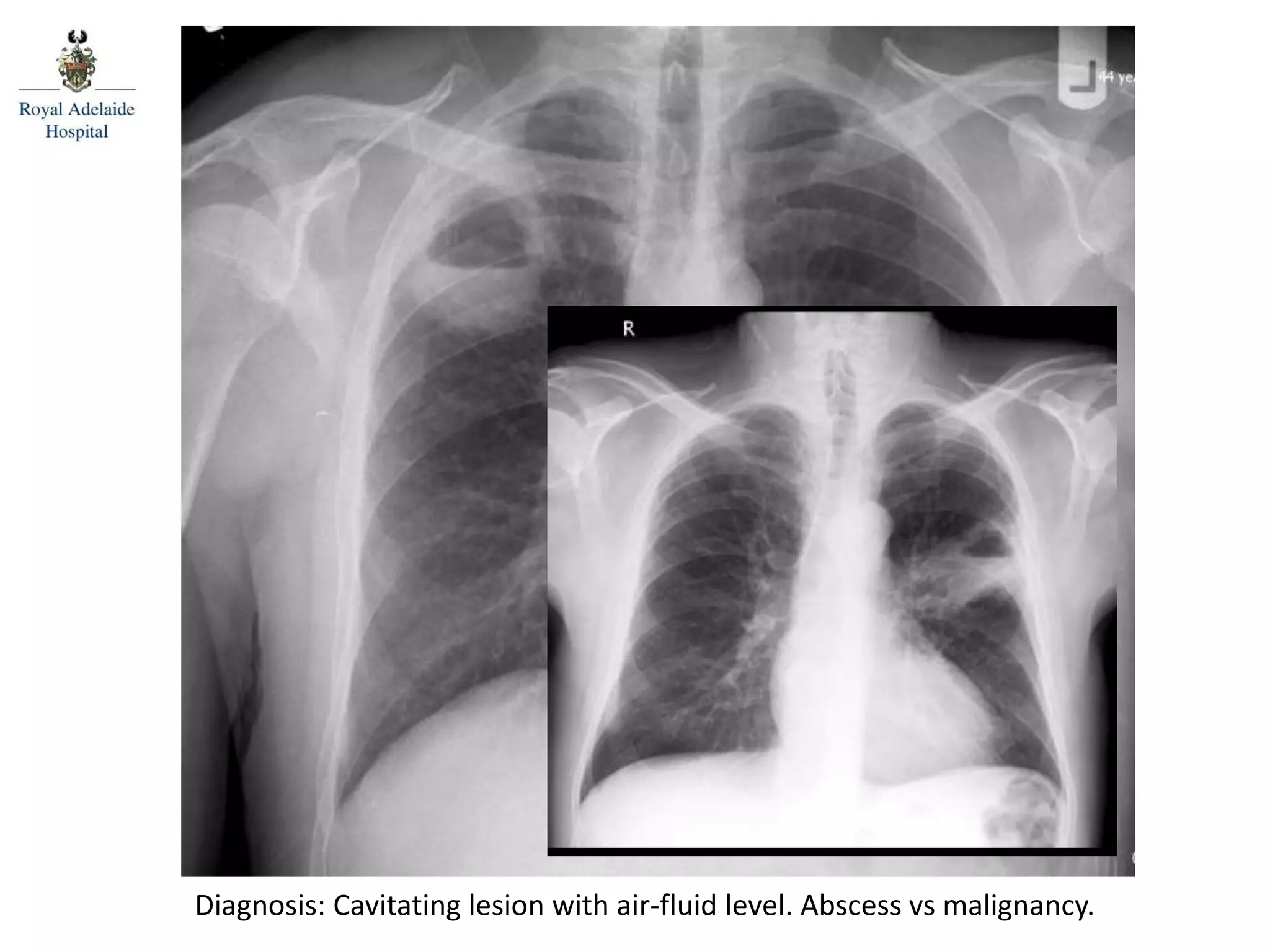 Diagnosis: Cavitating lesion with air-fluid level. Abscess vs malignancy.
 