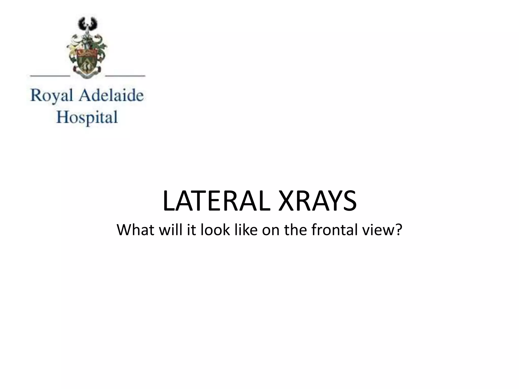 LATERAL XRAYS
What will it look like on the frontal view?
 