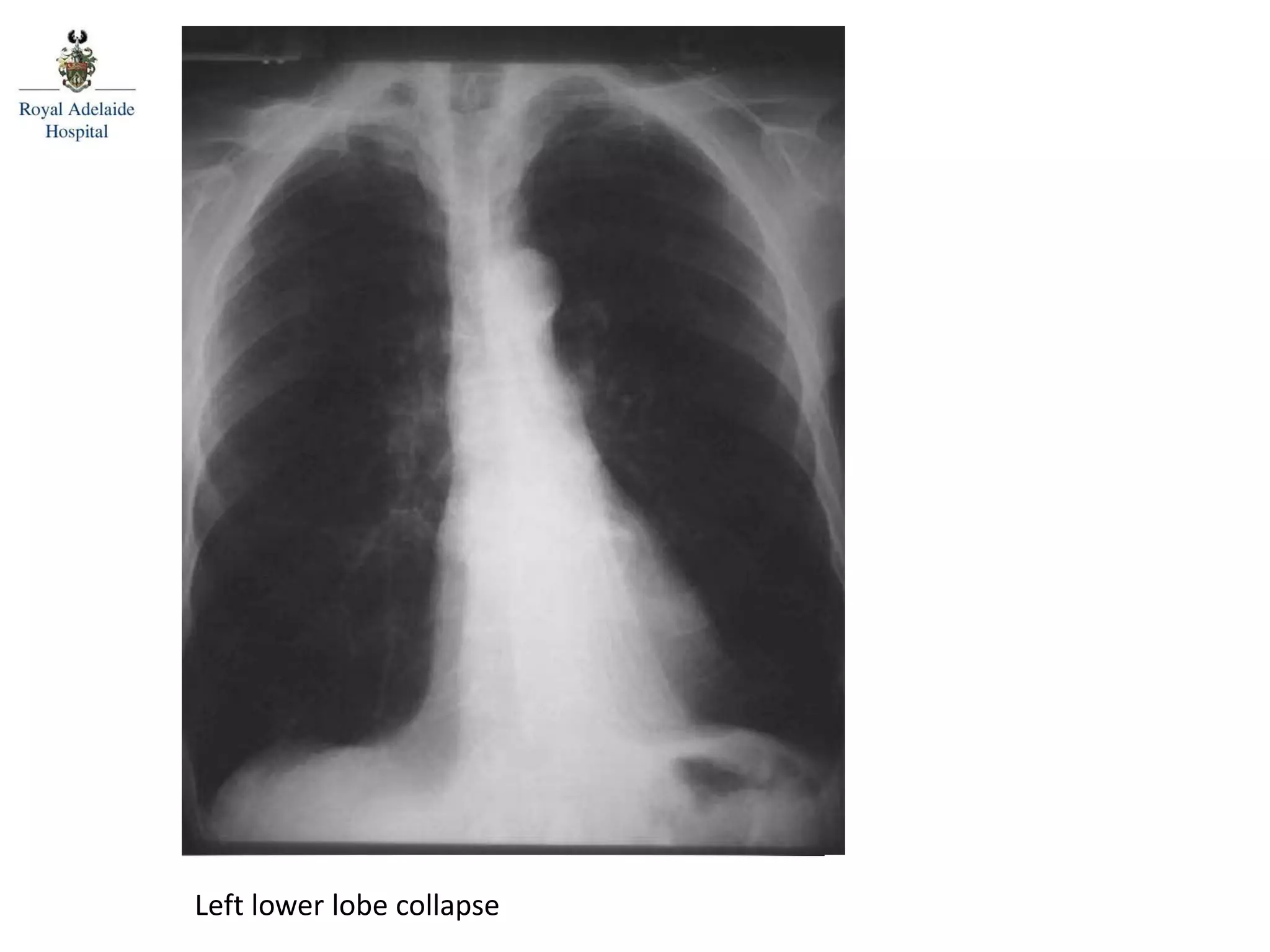 Left lower lobe collapse
 