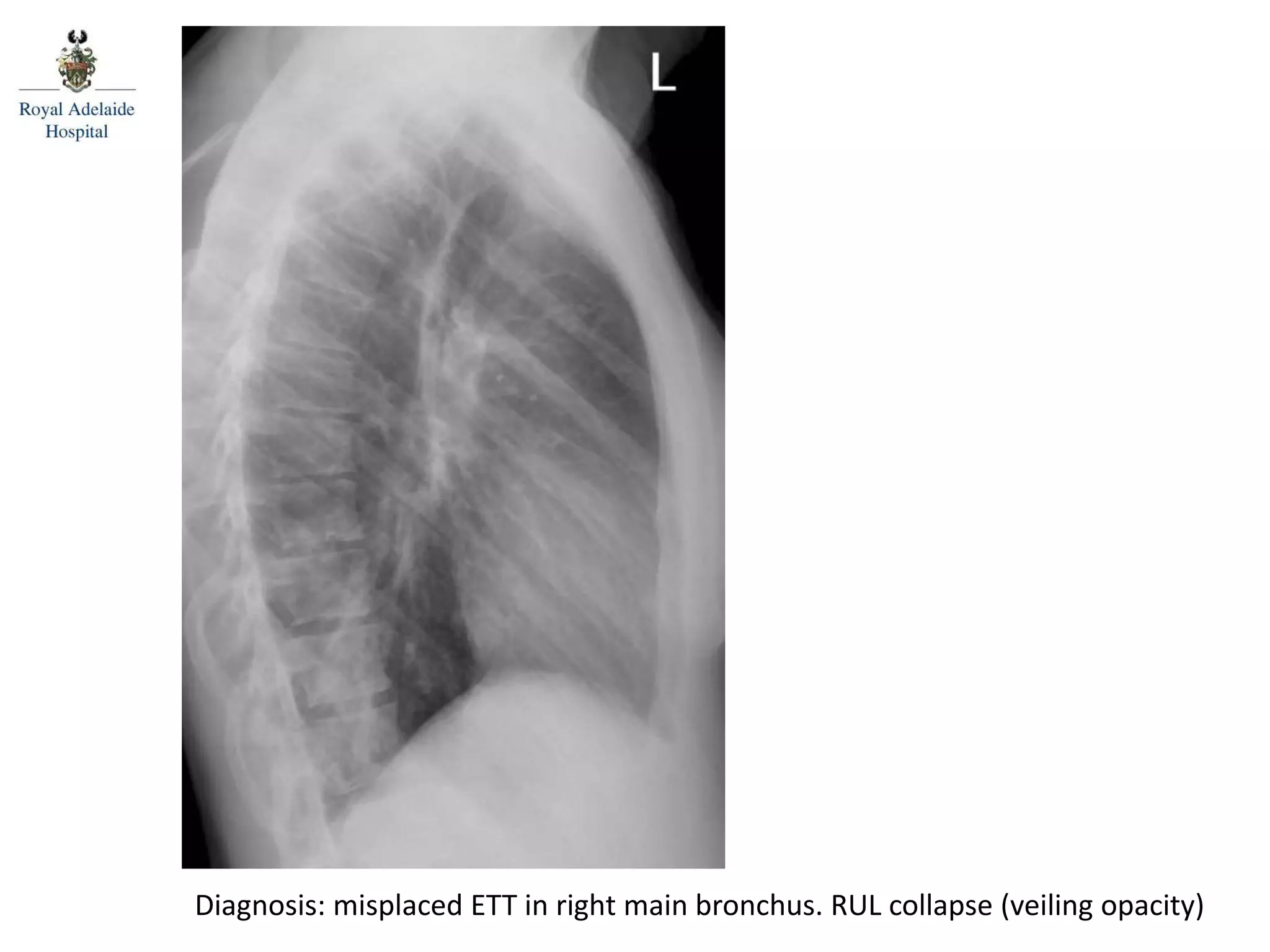 Diagnosis: misplaced ETT in right main bronchus. RUL collapse (veiling opacity)
 