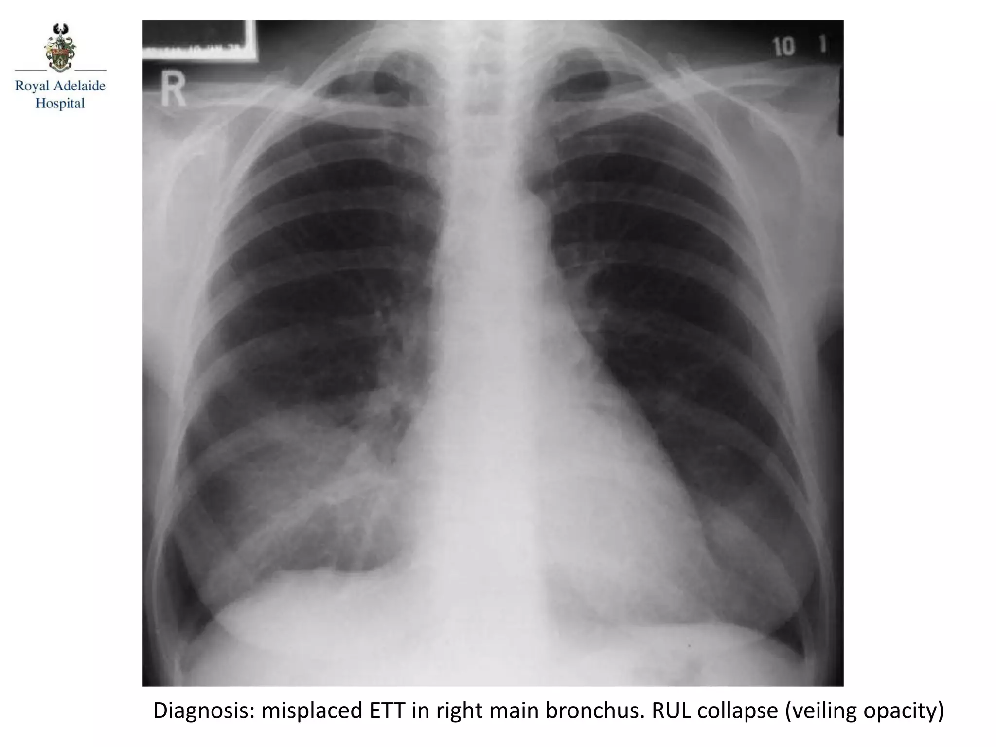 Diagnosis: misplaced ETT in right main bronchus. RUL collapse (veiling opacity)
 