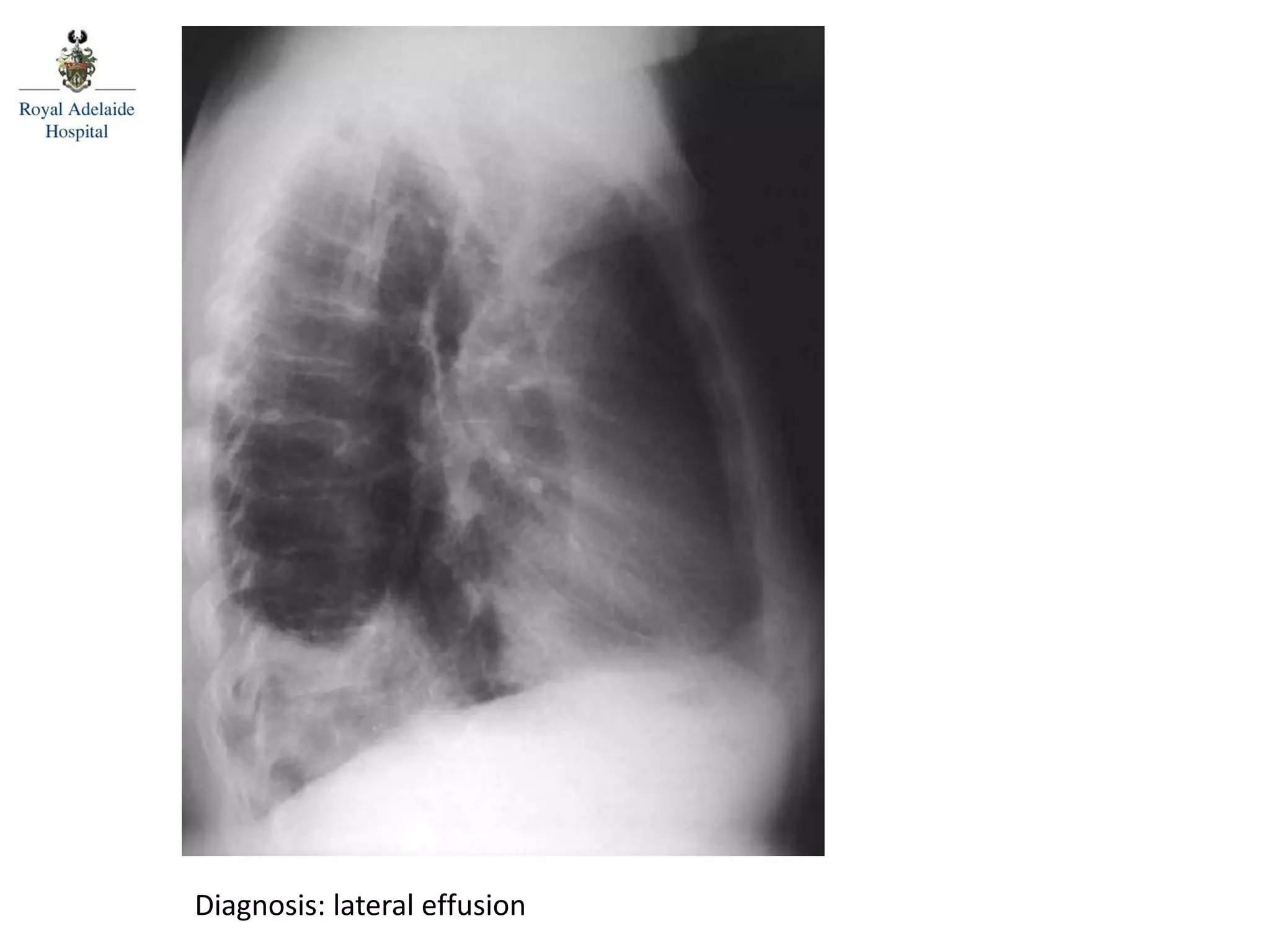 Diagnosis: lateral effusion
 