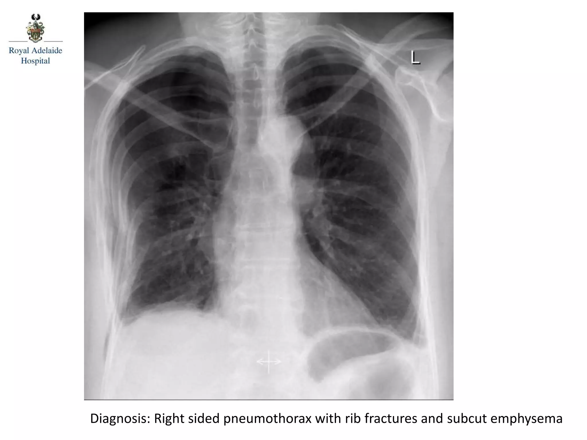 Diagnosis: Right sided pneumothorax with rib fractures and subcut emphysema
 