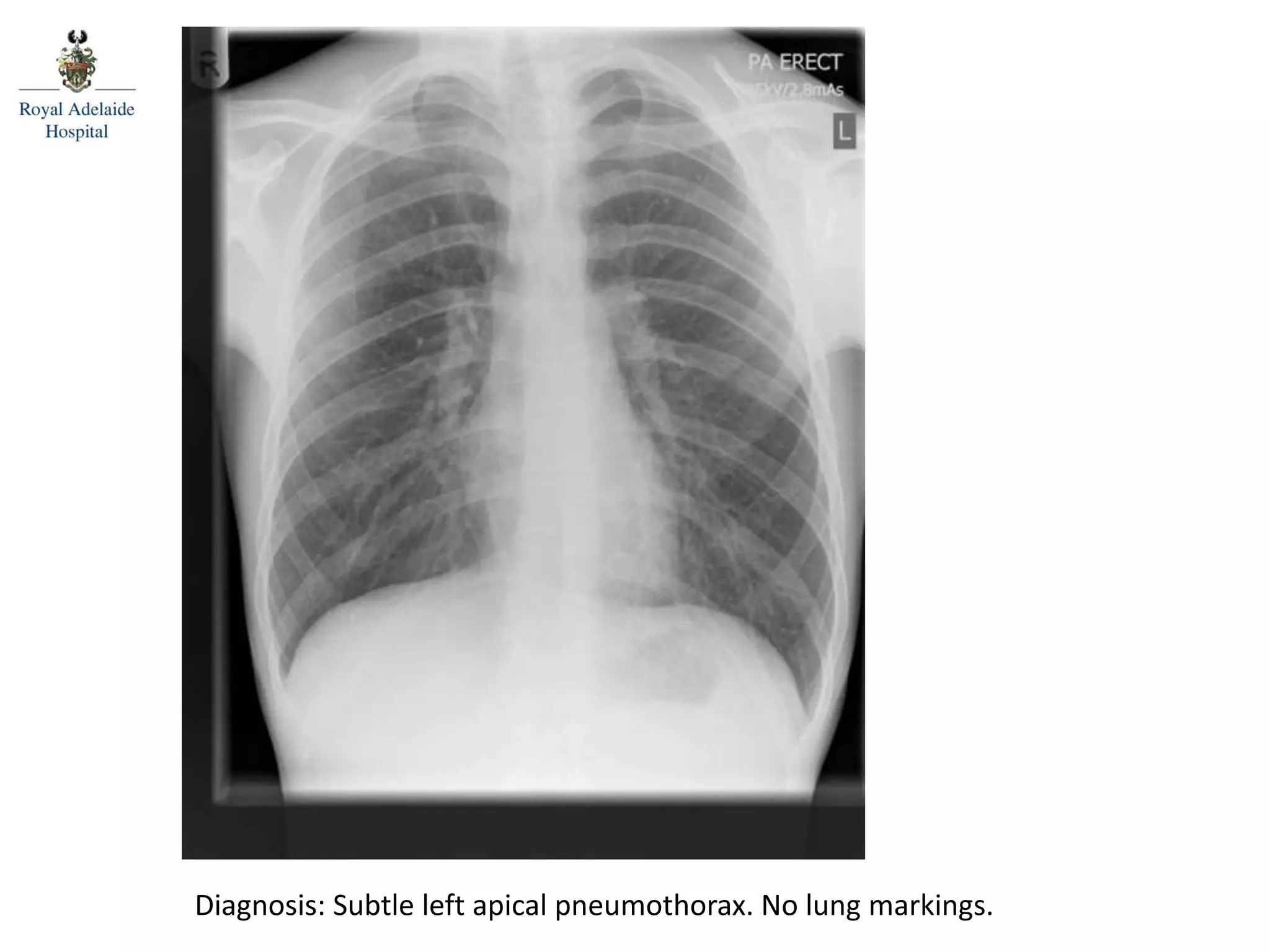 Diagnosis: Subtle left apical pneumothorax. No lung markings.
 