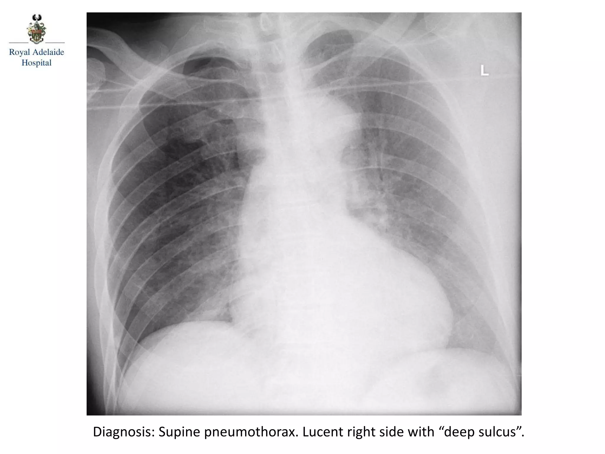 Diagnosis: Supine pneumothorax. Lucent right side with “deep sulcus”.
 