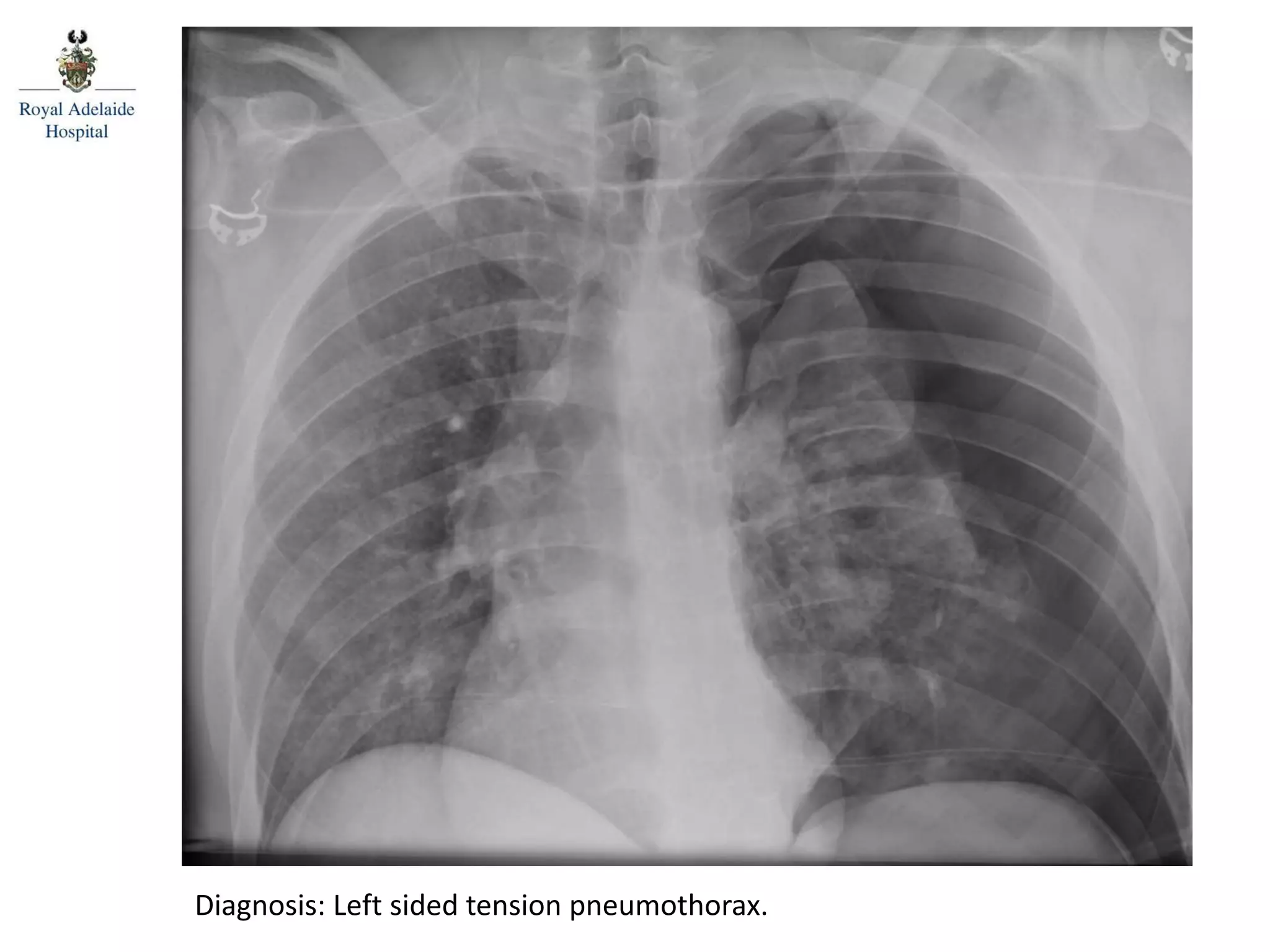 Diagnosis: Left sided tension pneumothorax.
 