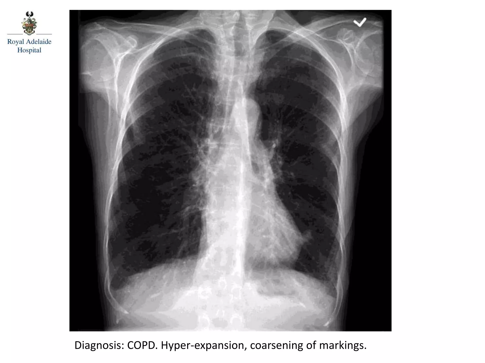Diagnosis: COPD. Hyper-expansion, coarsening of markings.
 