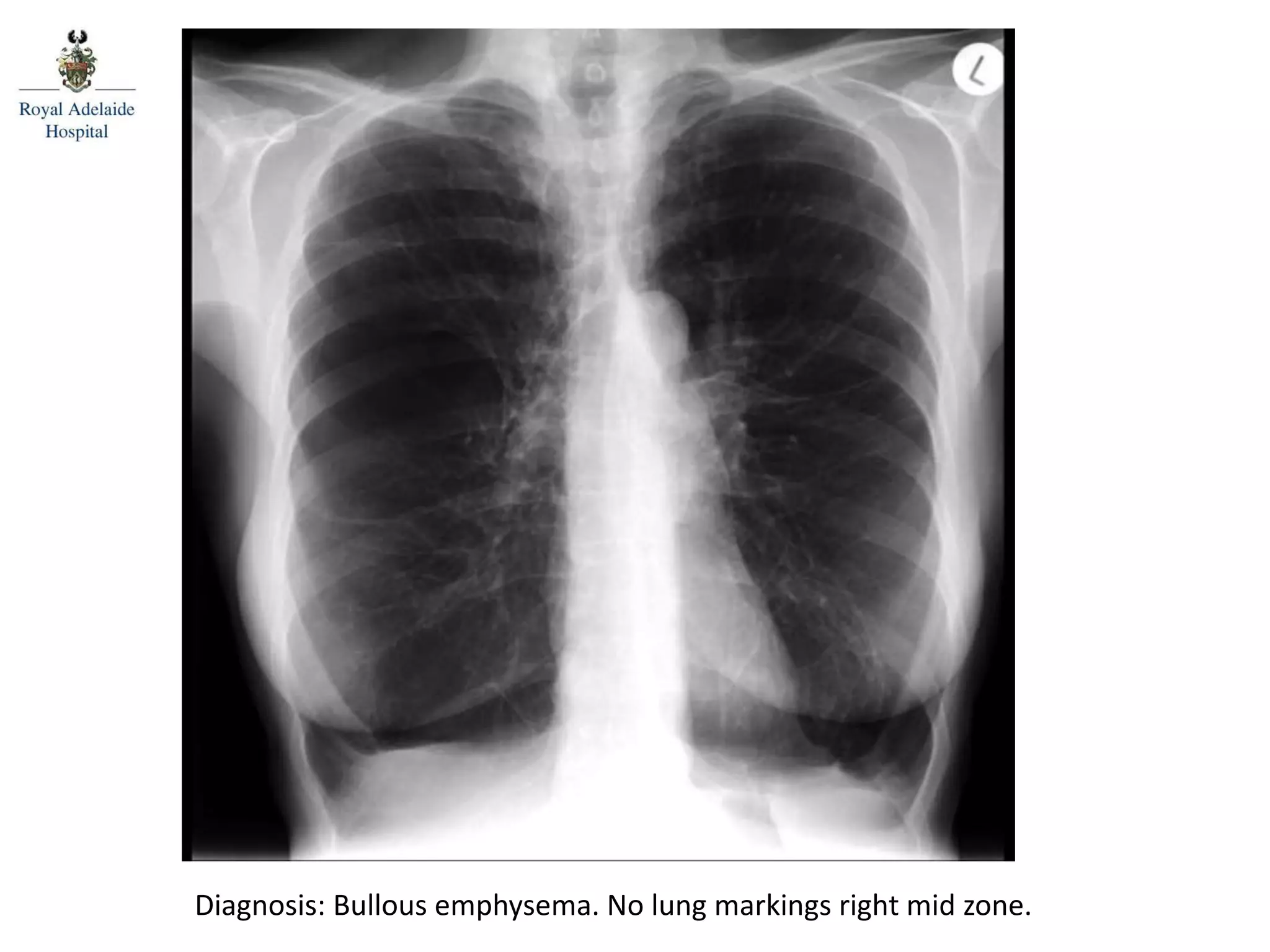 Diagnosis: Bullous emphysema. No lung markings right mid zone.
 