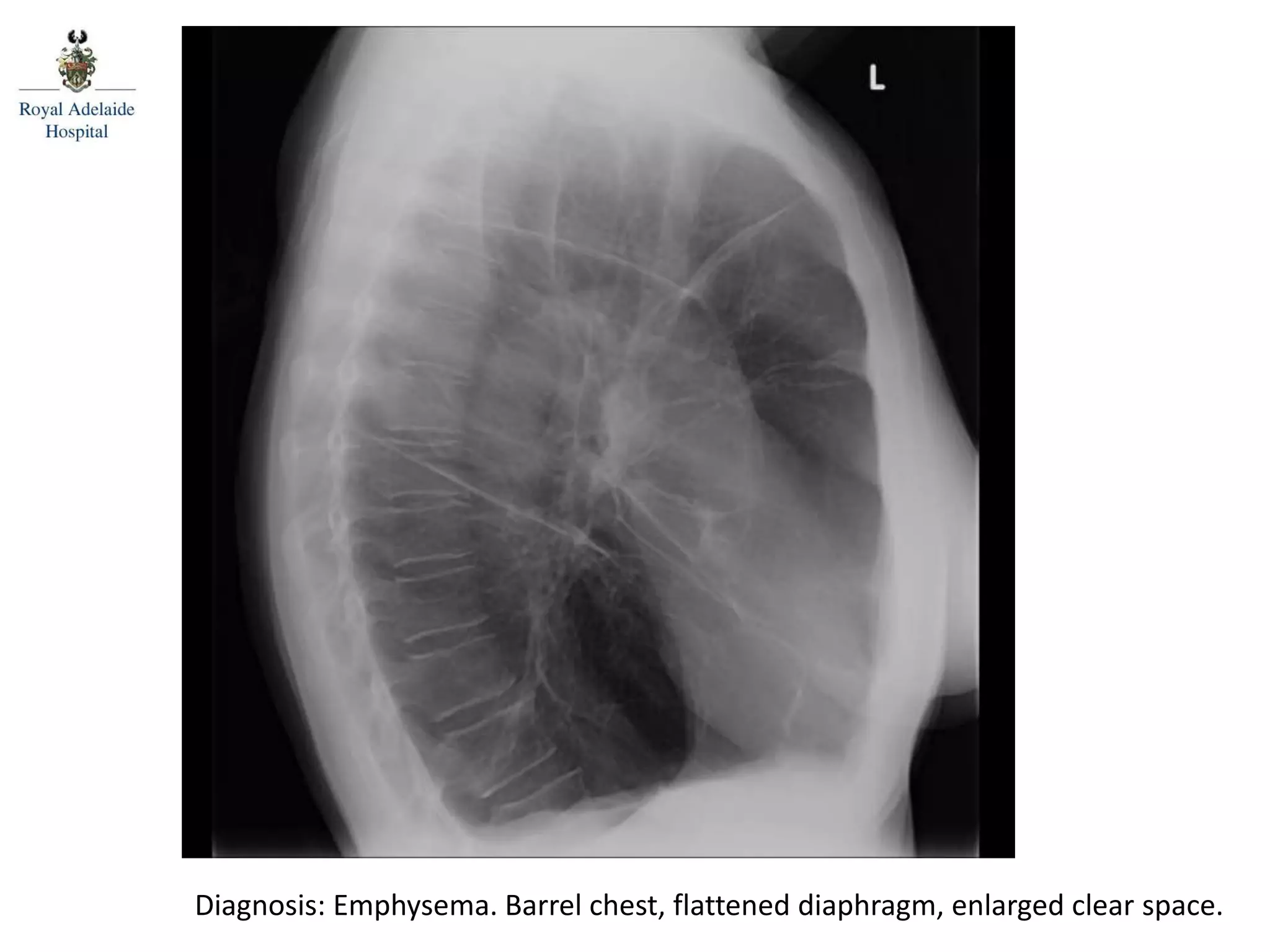 Diagnosis: Emphysema. Barrel chest, flattened diaphragm, enlarged clear space.
 