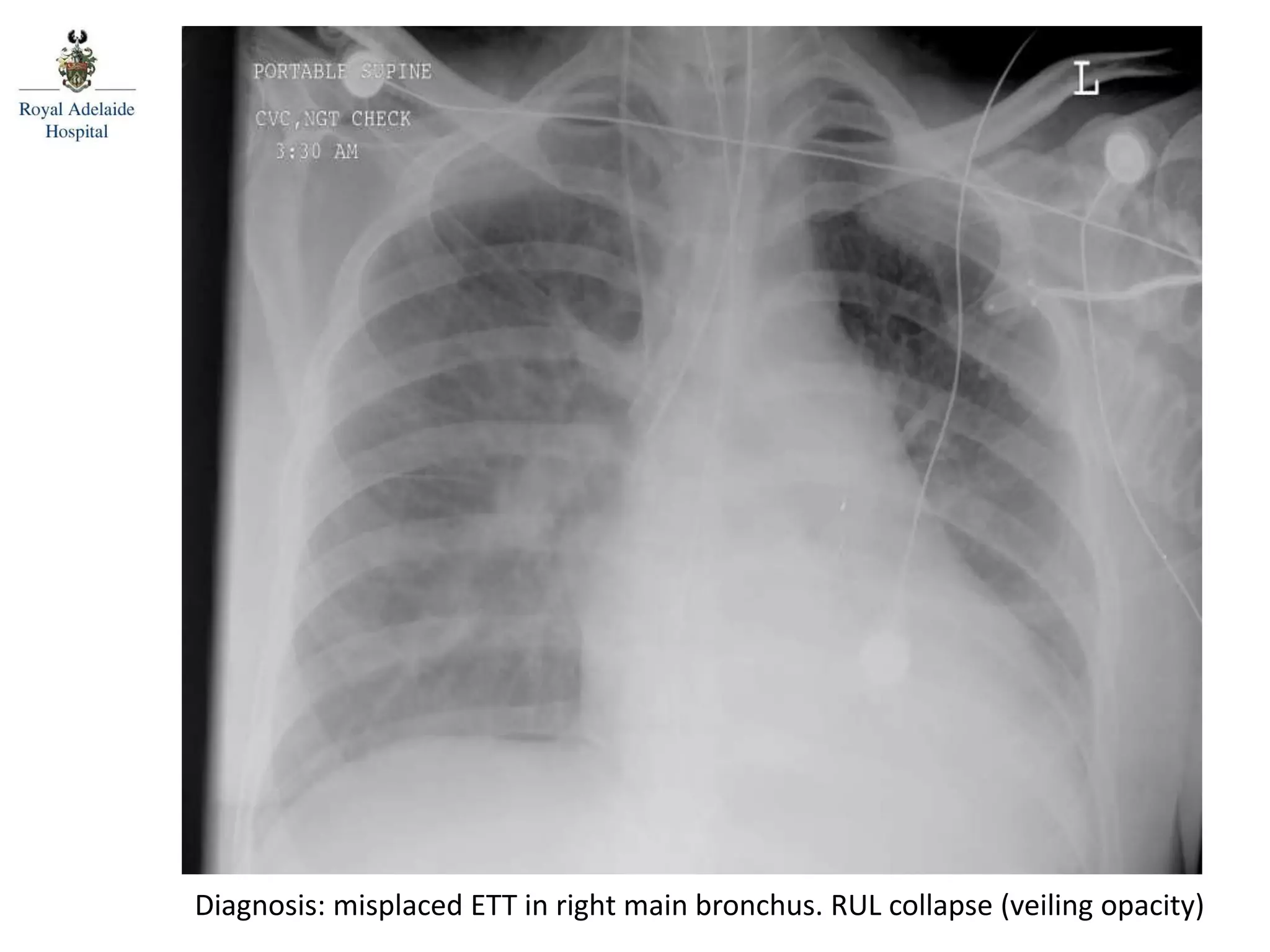 Diagnosis: misplaced ETT in right main bronchus. RUL collapse (veiling opacity)
 