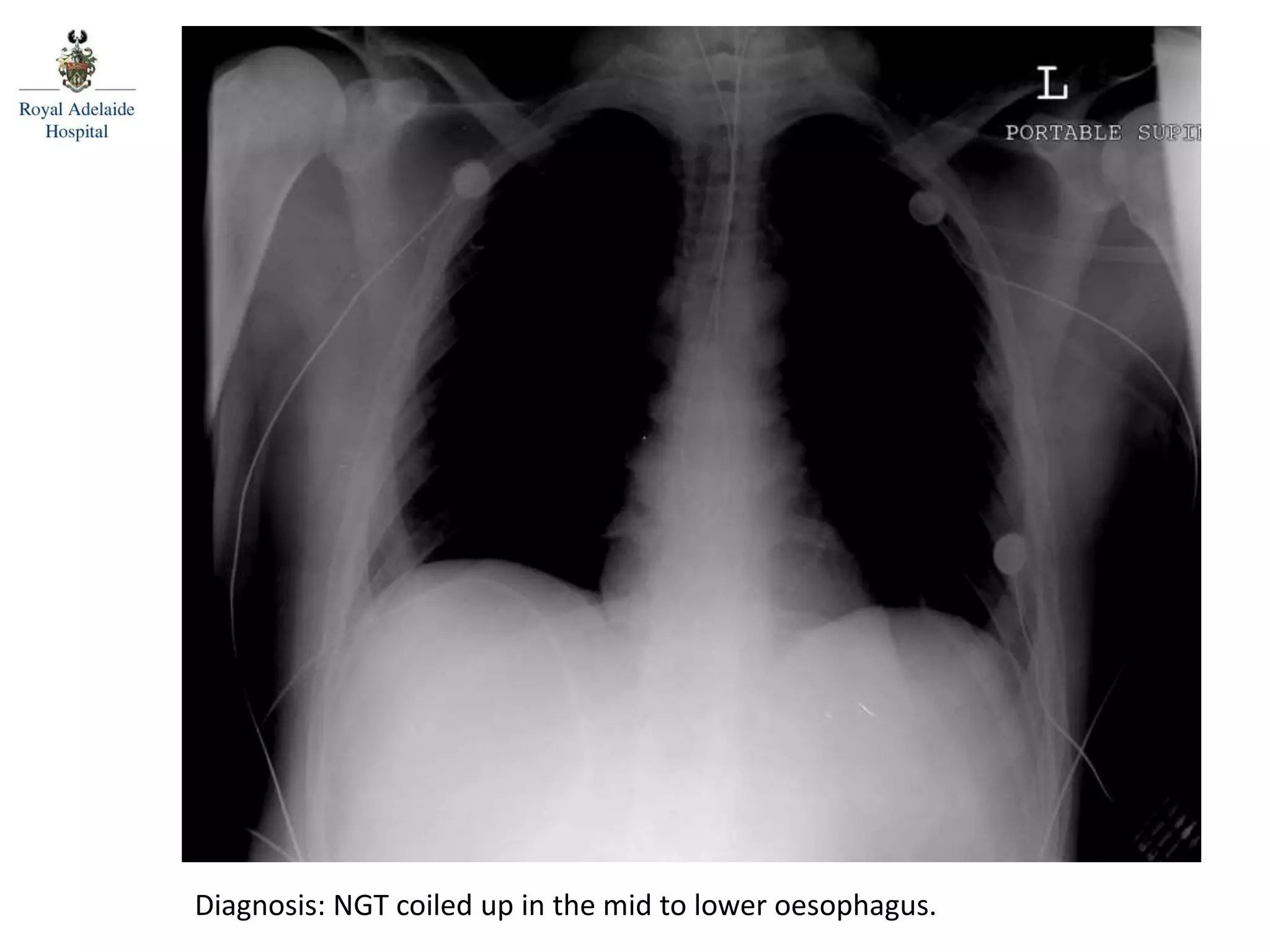Diagnosis: NGT coiled up in the mid to lower oesophagus.
 