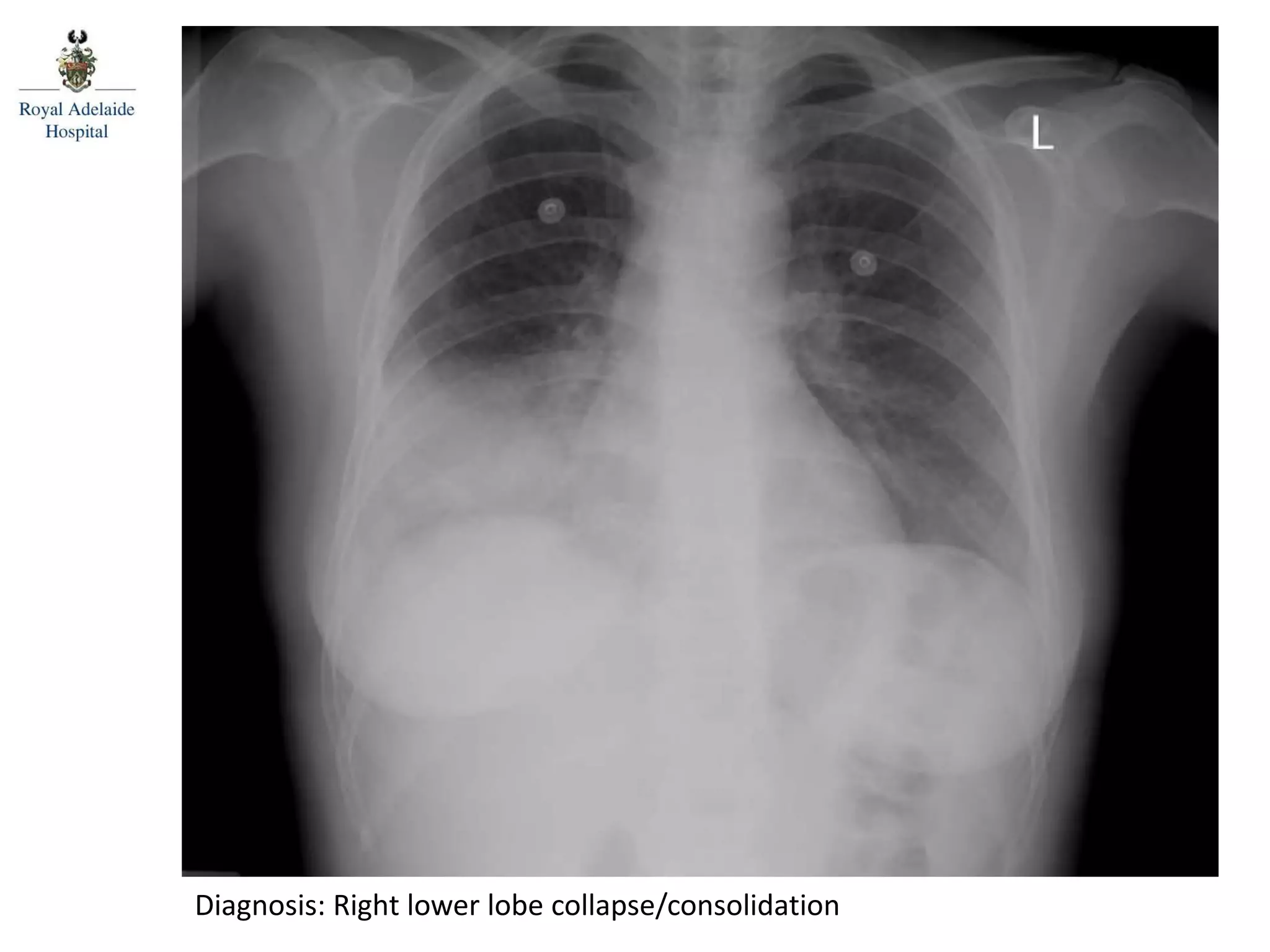 Diagnosis: Right lower lobe collapse/consolidation
 