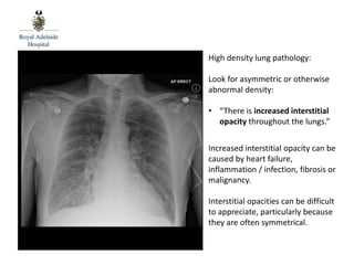 Heterogeneous Opacity RAH Med 4 MHU - Chest Xray 1 | PPTX