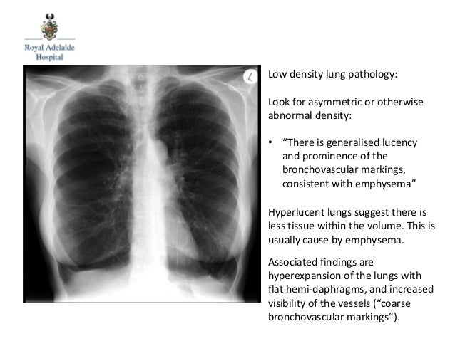 What Are Bronchovascular Markings Paperwingrvice web fc2 what-are-bronchovascular-markings-paperwingrvice-web-fc2