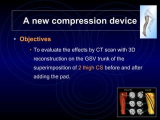 A new compression device Objectives  To evaluate the effects by CT scan with 3D reconstruction on the GSV trunk of the superimposition of  2 thigh CS  before and after adding the pad. 