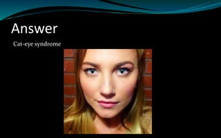 Answer
Cat-eye syndrome
 