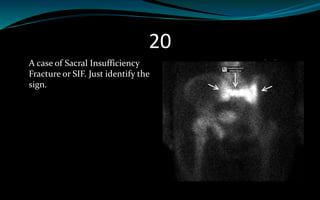 20
A case of Sacral Insufficiency
Fracture or SIF. Just identify the
sign.
 