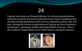 24
Leprosy, also known as Hansen’s disease, is a chronic granulomatous
infection caused by the bacteria Mycobacterium leprae. Symptoms that
develop include granulomas of the nerves, respiratory system, skin and
eyes. Among the various complications of Leprosy are loss of eyebrows
(madarosis), premature senility and mega lobules of ear etc. How is
the condition ‘mega lobules of ear’ better known among the masses?
 
