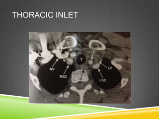 Thoracic Inlet Reflux CT ANATOMY OF NORMAL MEDIASTINUM MADE EASY | PPTX