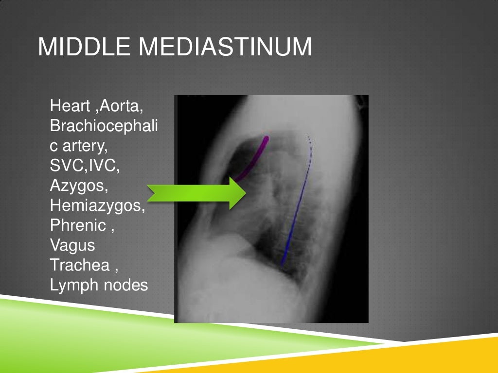 CT ANATOMY OF NORMAL MEDIASTINUM MADE EASY
