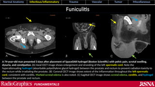 Funicularitis scrotum pathologies _media_aswani_45.12.pptx