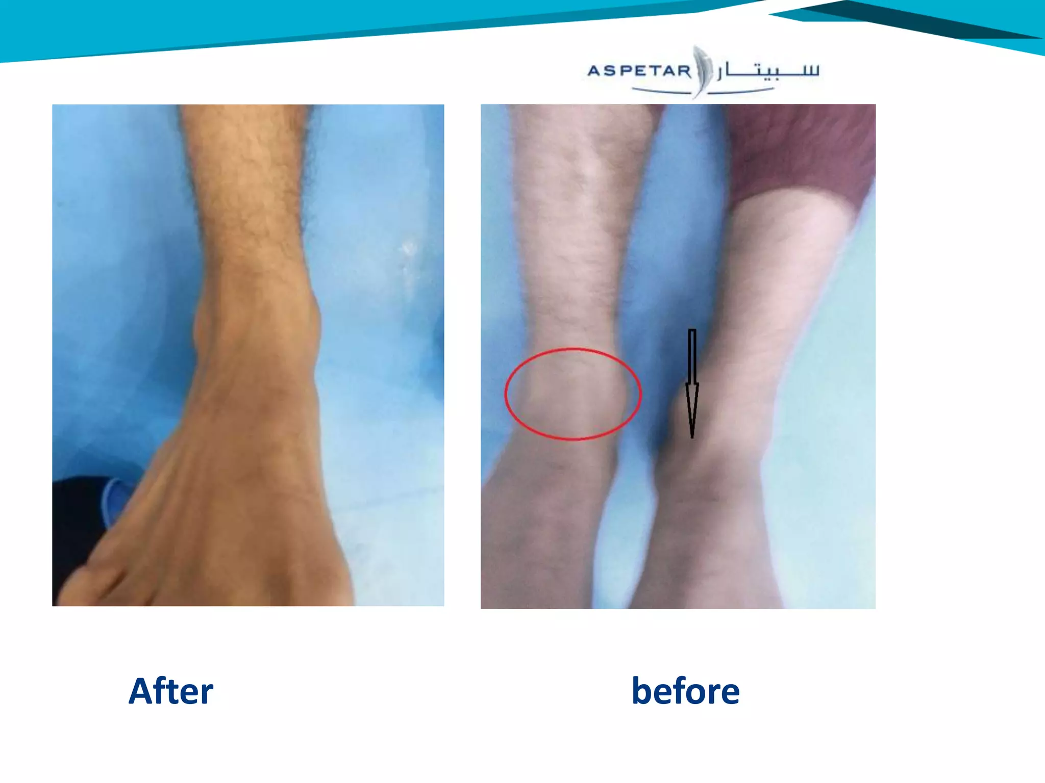 Medial ankle sprain | PPT