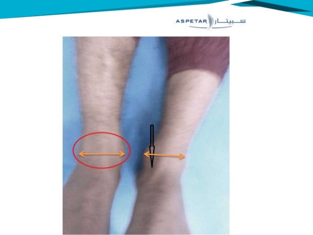 Medial Ankle Sprain