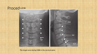 Cervical spine Medial branch block procedure | PPTX