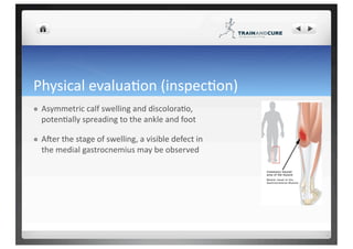 Medial calf muscle rupture | PDF