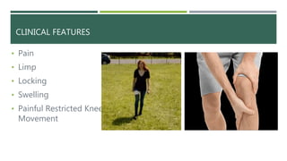 Medial meniscus injury and physiotherapy treatment @Dr.Muskan Rastogi ...