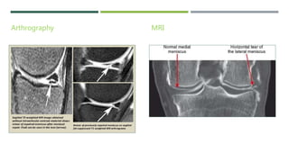 Medial meniscus injury and physiotherapy treatment @Dr.Muskan Rastogi ...