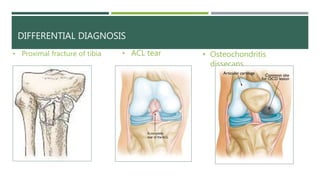 Medial meniscus injury and physiotherapy treatment @Dr.Muskan Rastogi ...
