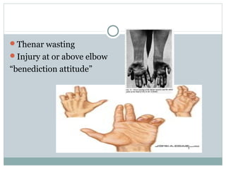 Thenar wasting
Injury at or above elbow
“benediction attitude”
 