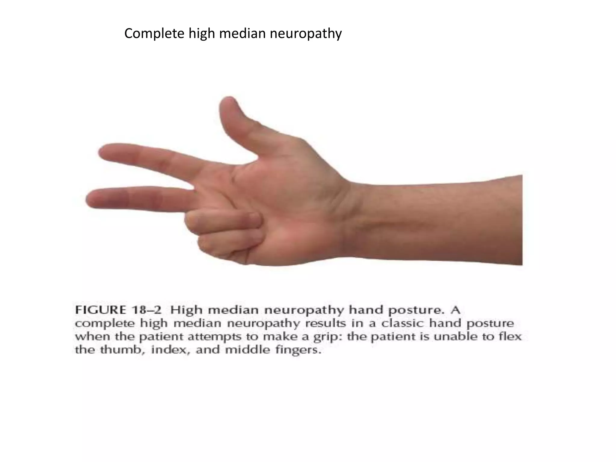 Complete high median neuropathy
 