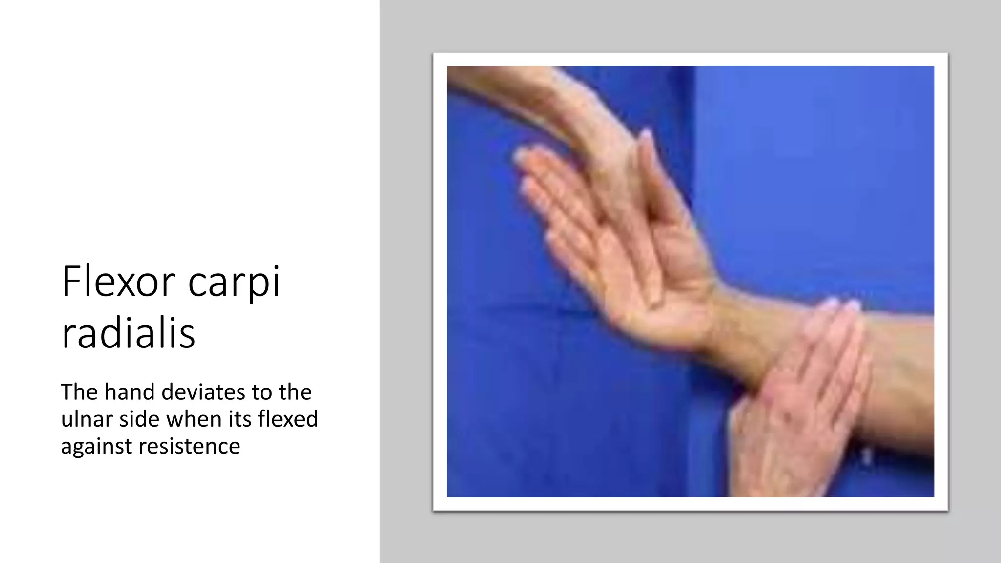 Flexor carpi
radialis
The hand deviates to the
ulnar side when its flexed
against resistence
 