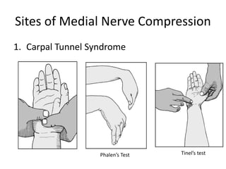 Sites of Medial Nerve Compression
1. Carpal Tunnel Syndrome
Phalen’s Test Tinel’s test
 