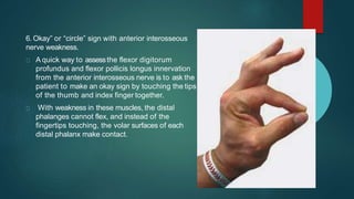 6. Okay” or “circle” sign with anterior interosseous
nerve weakness.
A quick way to assessthe flexor digitorum
profundus and flexor pollicis longus innervation
from the anterior interosseous nerve is to ask the
patient to make an okay sign by touching the tips
of the thumb and index finger together.
With weakness in these muscles, the distal
phalanges cannot flex, and instead of the
fingertips touching, the volar surfaces of each
distal phalanx make contact.
 