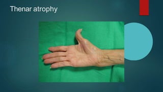 Thenar atrophy
 