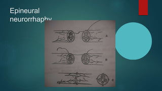 Epineural
neurorrhaphy
 