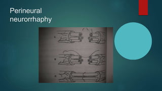 Perineural
neurorrhaphy
 