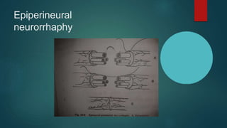 Epiperineural
neurorrhaphy
 