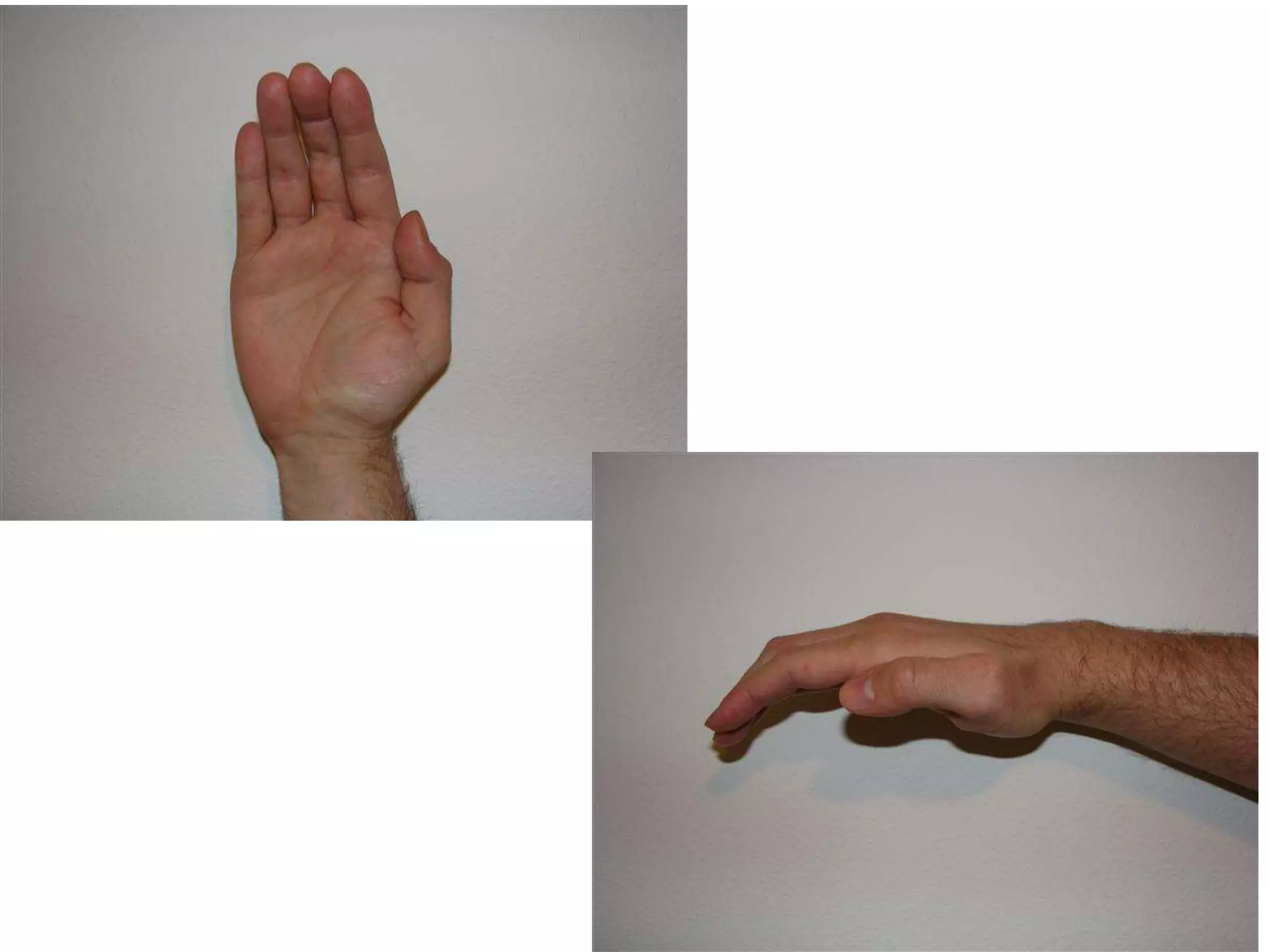 Ape Hand Deformity Median Nerve