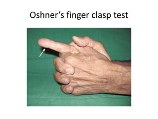 Oshner’s finger clasp test
 
