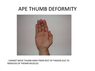 APE THUMB DEFORMITY
- CANNOT MOVE THUMB AWAY FROM REST OF FINGERS DUE TO
PARALYSIS OF THENAR MUSCLES
 