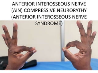 ANTERIOR INTEROSSEOUS NERVE
(AIN) COMPRESSIVE NEUROPATHY
(ANTERIOR INTEROSSEOUS NERVE
SYNDROME)
 
