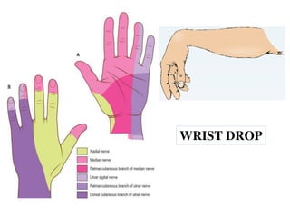 Drop Injury median and ulnar nerve injuries for mbbs students | PDF