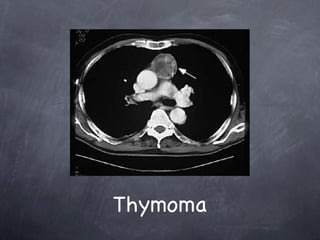 Mediastinal Mass