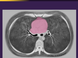 Mediastinal  Pathology  Compartmental  Approach