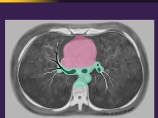 Mediastinal  Pathology  Compartmental  Approach